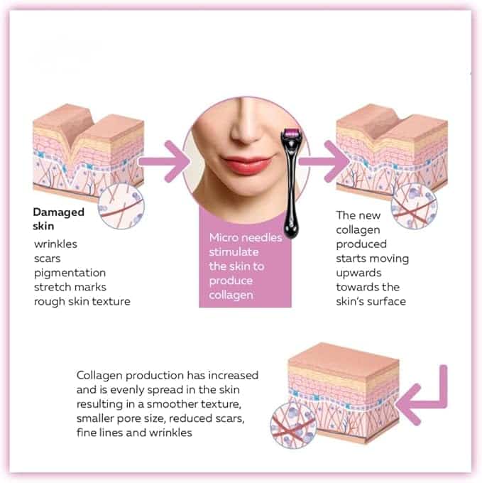 Derma Roller System 540 Needles Derma for Face and Skin Care – 0.25mm